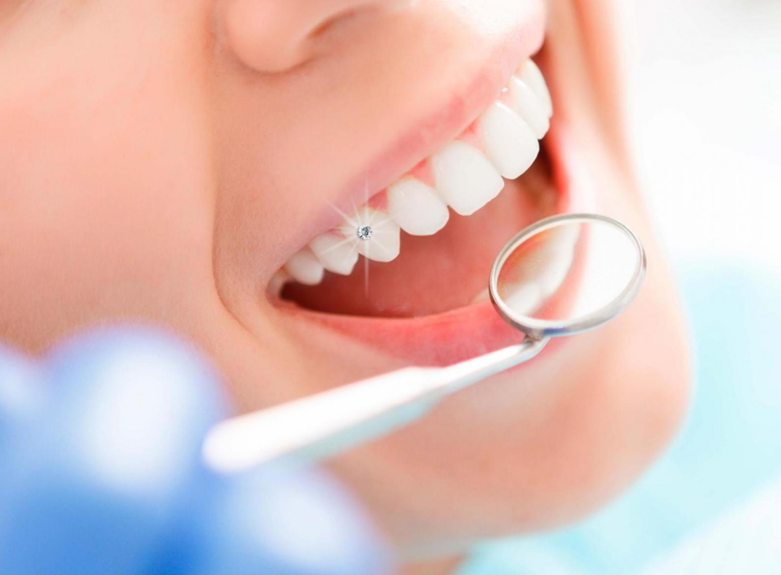 Đính đá trên răng có gây ê buốt không? Những lưu ý khi đính đá trên răng
