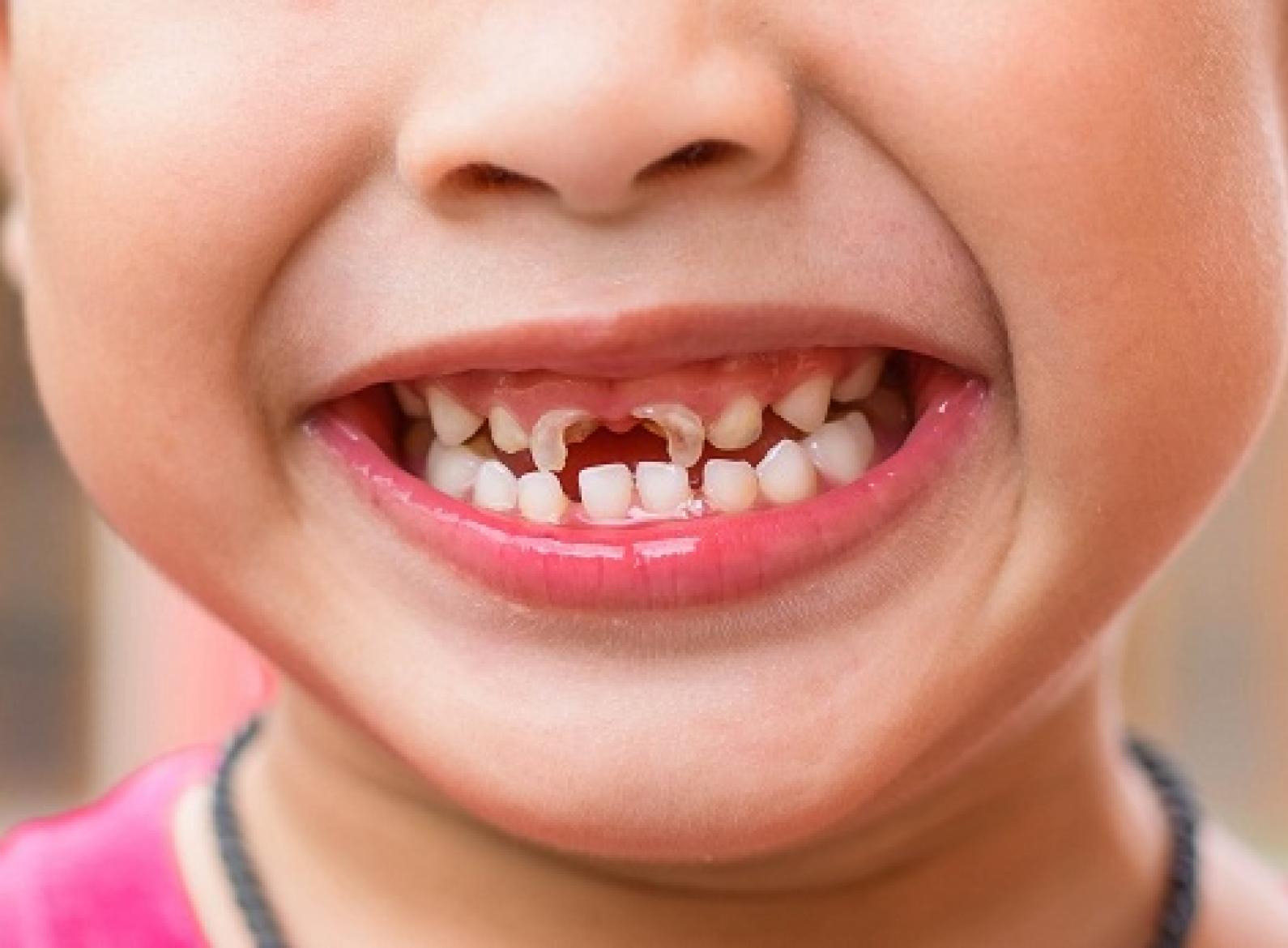 Tại sao các bé 3-4 tuổi lại có tỷ lệ sâu răng cao? nguyên nhân, hậu quả và cách phòng ngừa,chữa trị tình trạng sâu răng cho bé.
