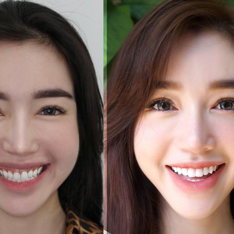 Thẩm mỹ cười hở lợi Thẩm mỹ cười hở lợi