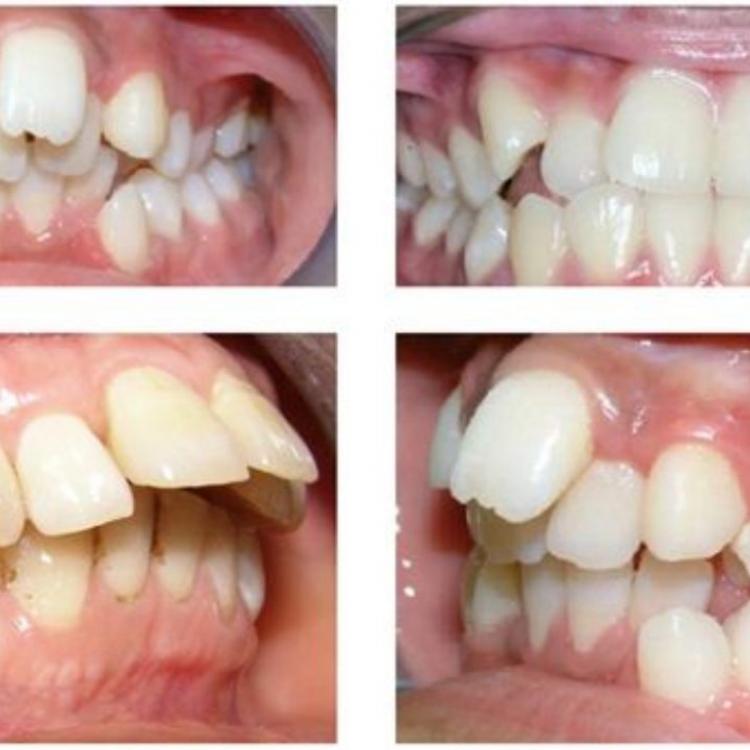 Xử lý răng mọc sai vị trí ở Hải Phòng bằng cách nào?