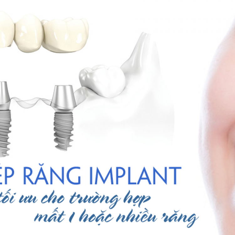 Cấy ghép Implant nha khoa Cấy ghép Implant nha khoa