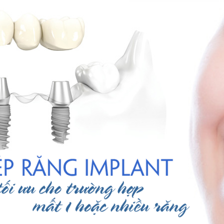 Cấy ghép Implant nha khoa