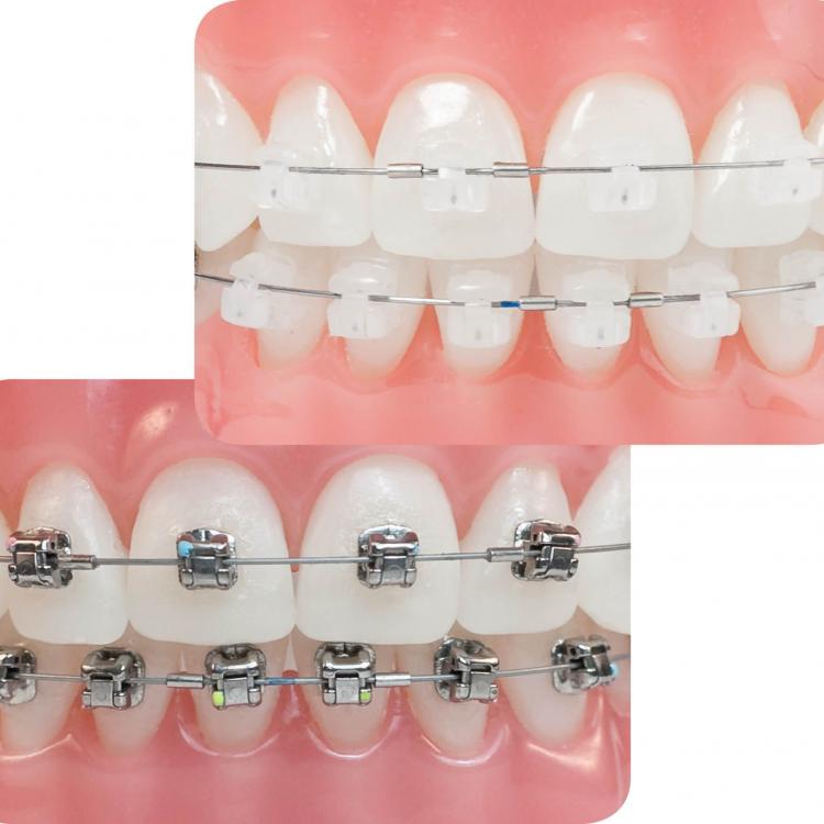 Niềng răng (Chỉnh nha) mắc cài Niềng răng (Chỉnh nha) mắc cài