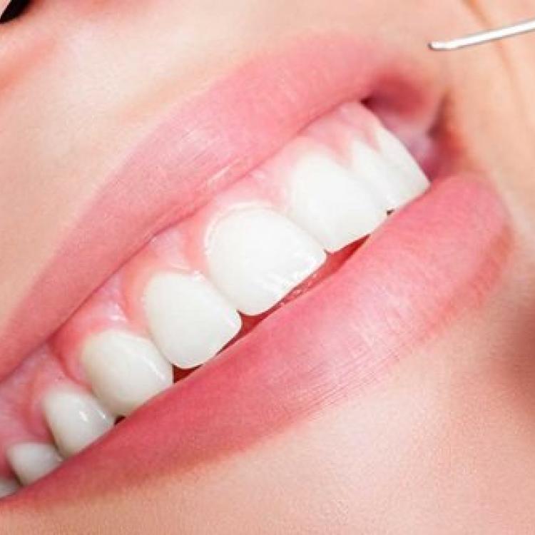 Dịch vụ răng sứ thẩm mỹ ngày càng được nhiều người lựa chọn