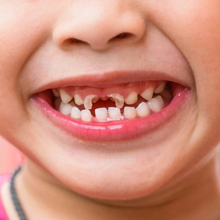 Tại sao các bé 3-4 tuổi lại có tỷ lệ sâu răng cao? nguyên nhân, hậu quả và cách phòng ngừa,chữa trị tình trạng sâu răng cho bé.