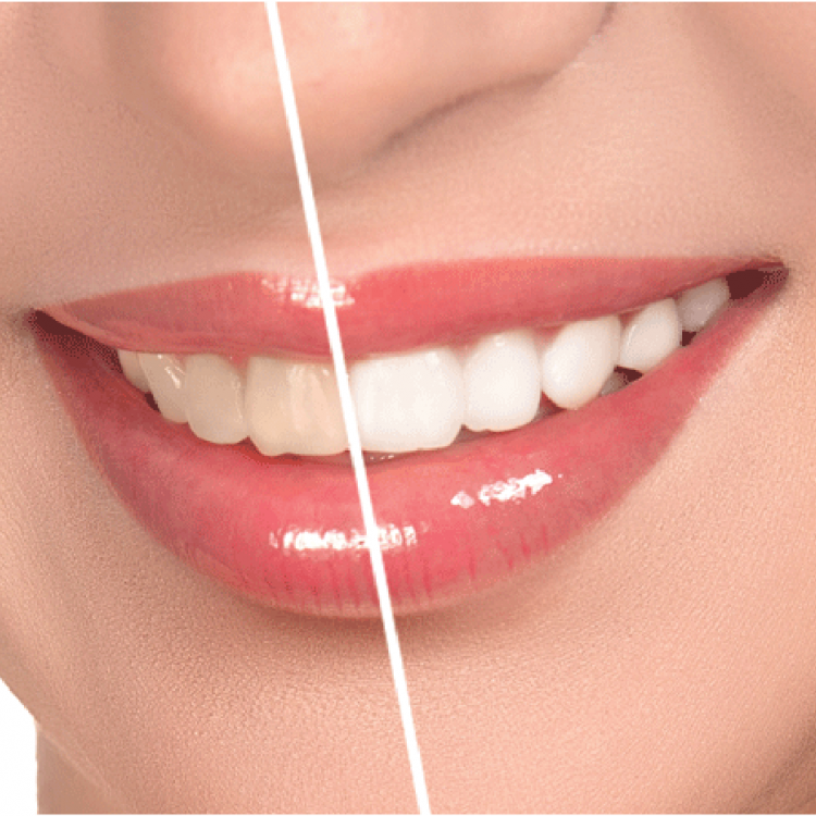 Tẩy trắng răng Tẩy trắng răng