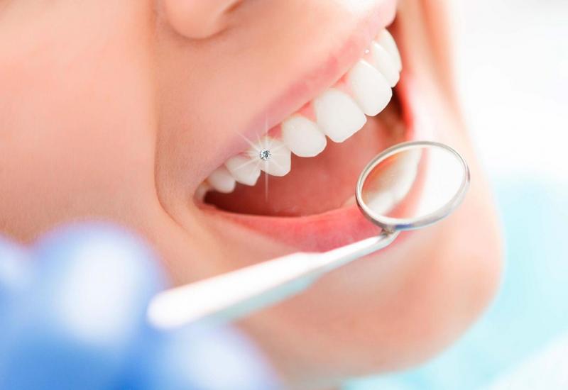 Đính đá trên răng có gây ê buốt không? Những lưu ý khi đính đá trên răng