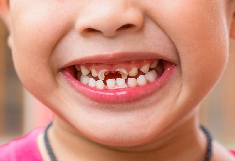 Tại sao các bé 3-4 tuổi lại có tỷ lệ sâu răng cao? nguyên nhân, hậu quả và cách phòng ngừa,chữa trị tình trạng sâu răng cho bé.